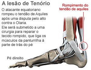 tendao de aquiles carlos tenório