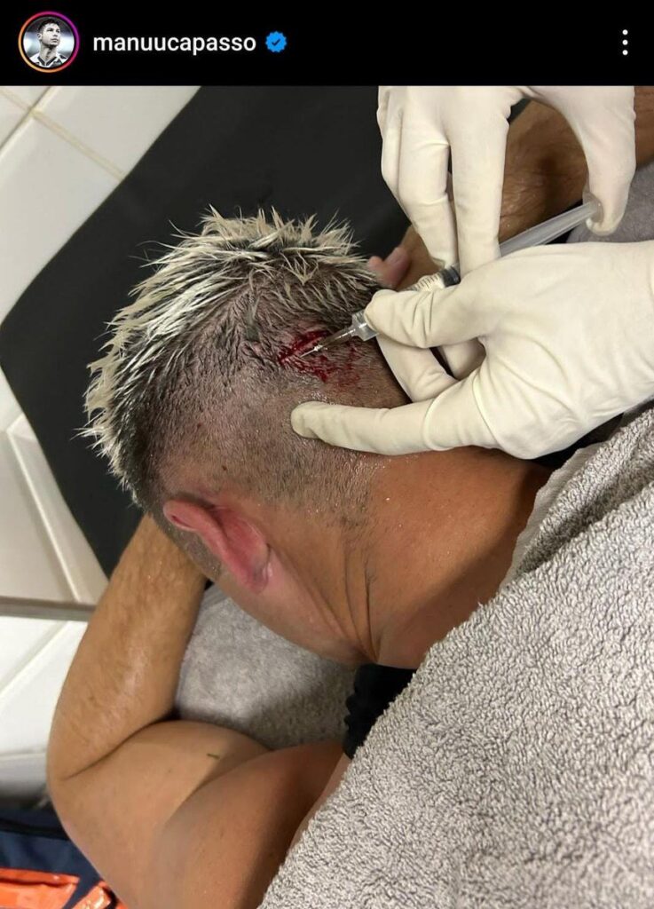 Capasso mostra machucado na cabeça após cotovelada